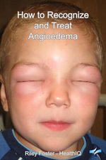 How to Recognize and Treat Angioedema - Riley Foster
