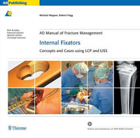 AO Manual of Fracture Management: Internal Fixators : Concepts and Cases using LCP/LISS - Michael Wagner