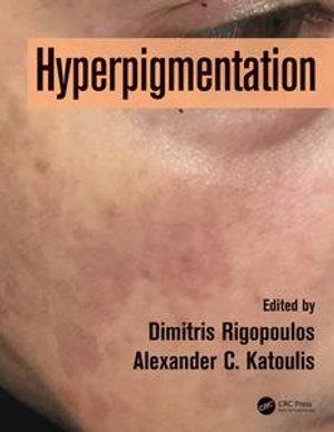 Hyperpigmentation - Dimitris Rigopoulos